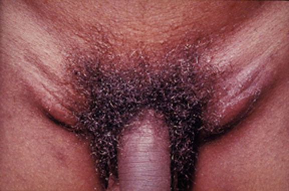 Chlamydia can cause swelling of the pubic lymph nodes