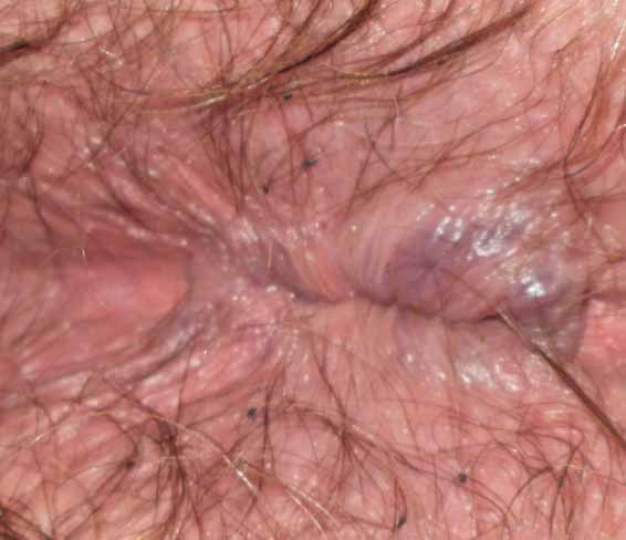 Anal pubic lice infestation
