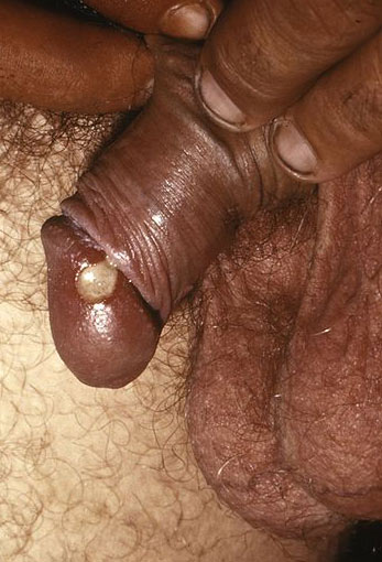 Chancroid puss filled sac prior to bursting open.