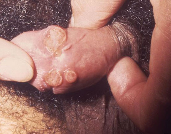 Above is a photo picture of Donovanosis on male genitals Penis Above is a photo picture of Donovanosis on male genitals Penis