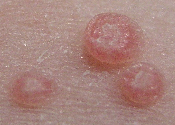 This photo picture is of Molluscum Contagiousum taken close up.