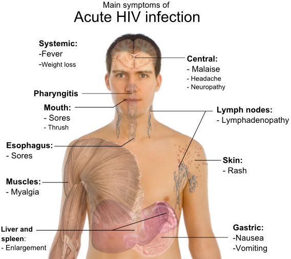 The symptoms of acute HIV infection - what to expect when first infected with HIV