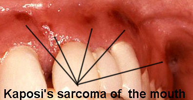Herpes virus type 8 can cause Kaposi's sarcoma of the mouth