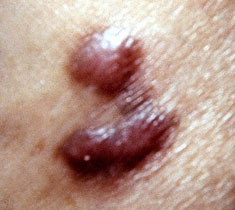 Kaposi's sarcoma skin lesion caused by hepatitis type 8