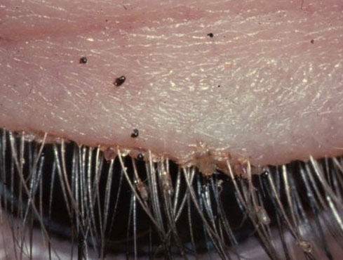 pubic lice on eye lid