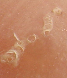 scabbies burrow into human skin