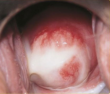 do it can cause infertility and pelvic inflammatory disease. do it can cause infertility and pelvic inflammatory disease.