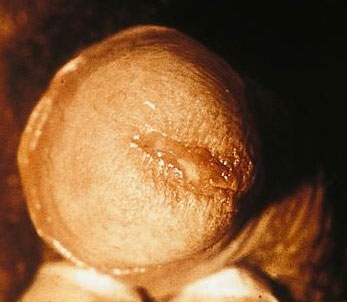 Male genital Chlamydia  of the penis