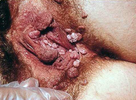 Genital warts of the vagina