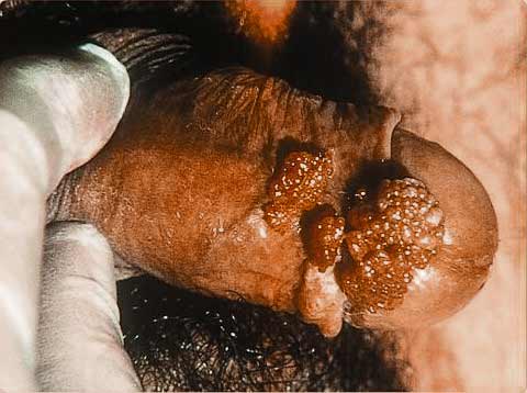 soa-aids-amsterdam-condylomata-acuminata-man-warts-penis.jpg