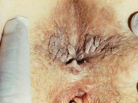 anal genital warts