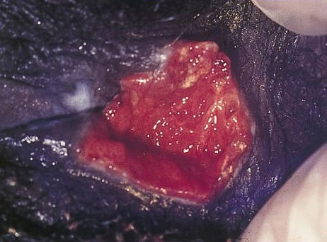 Donovanosis on female vagina-genitals