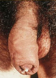 male Gonorrhea in penis / genitals