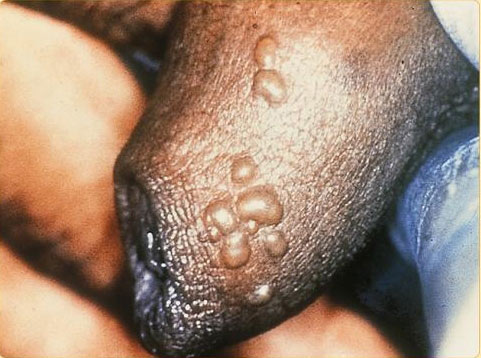 The above photo picture shows herpes of the penis The above two genital The above photo picture shows herpes of the penis The above two genital