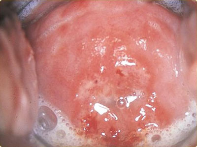 Urethritis of the female vagina