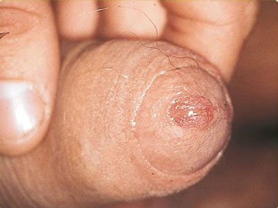 Urthritis of the male penis