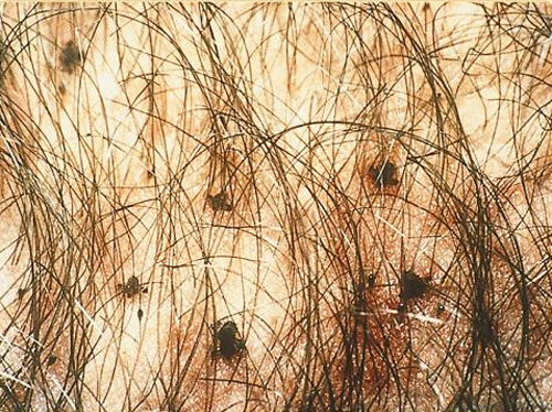 pubic lice in pubic area or hair area