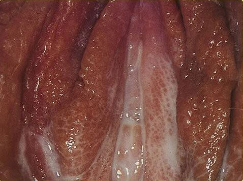 Gonorrhea of female genitals: Vaginal