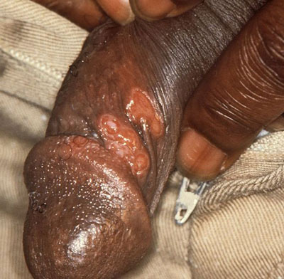 Syphilis of the male genital - penis