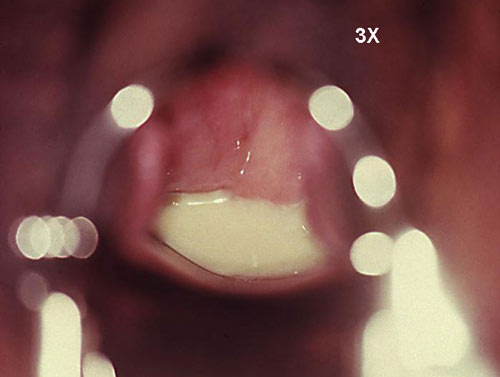 Trichomonal vaginitis