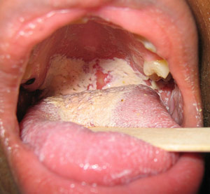 Mouth / oral yeast infection aka oral thrush or oral candidiasis.